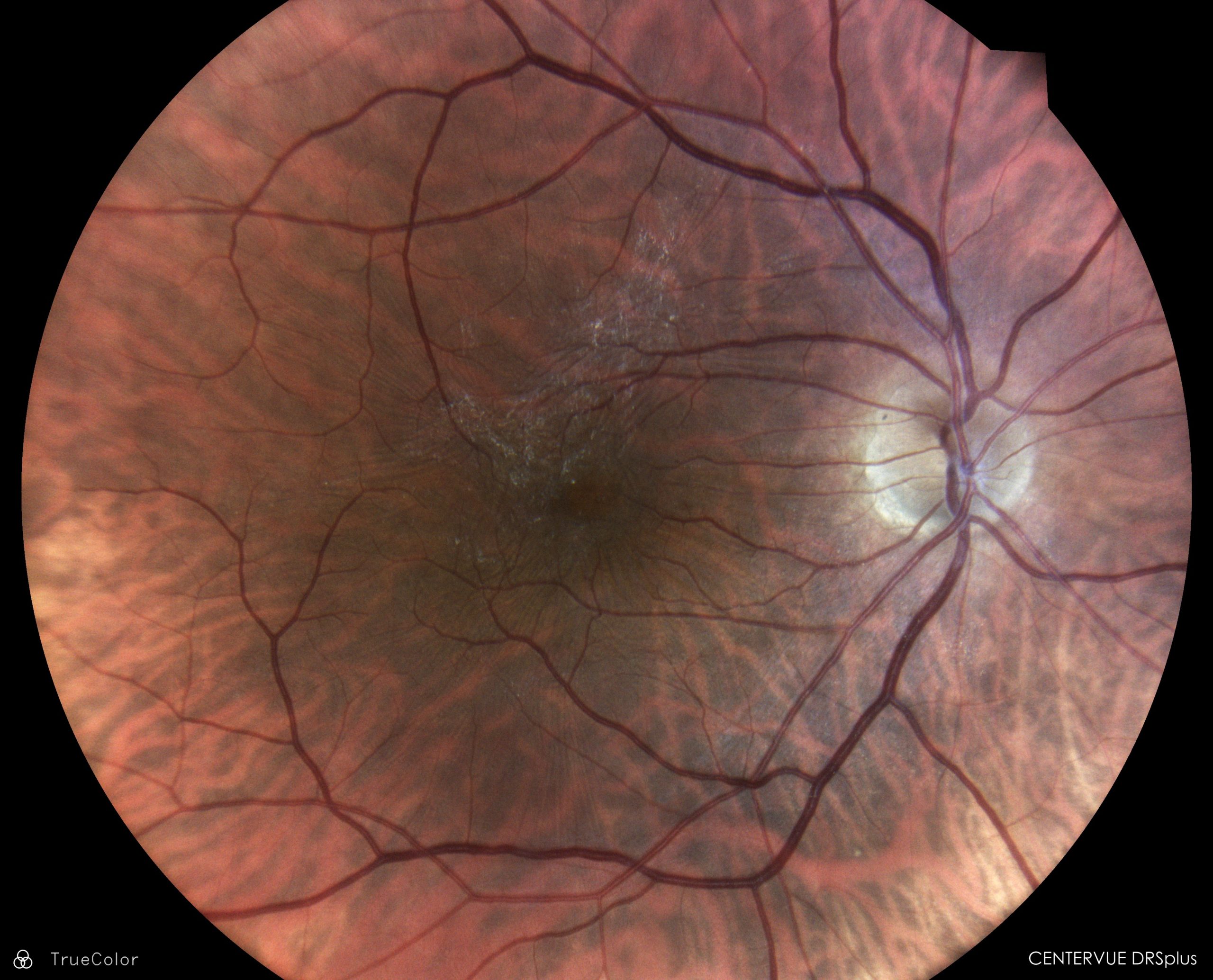 iCare DRSplus Fundus Görüntüleme - Görsel 2