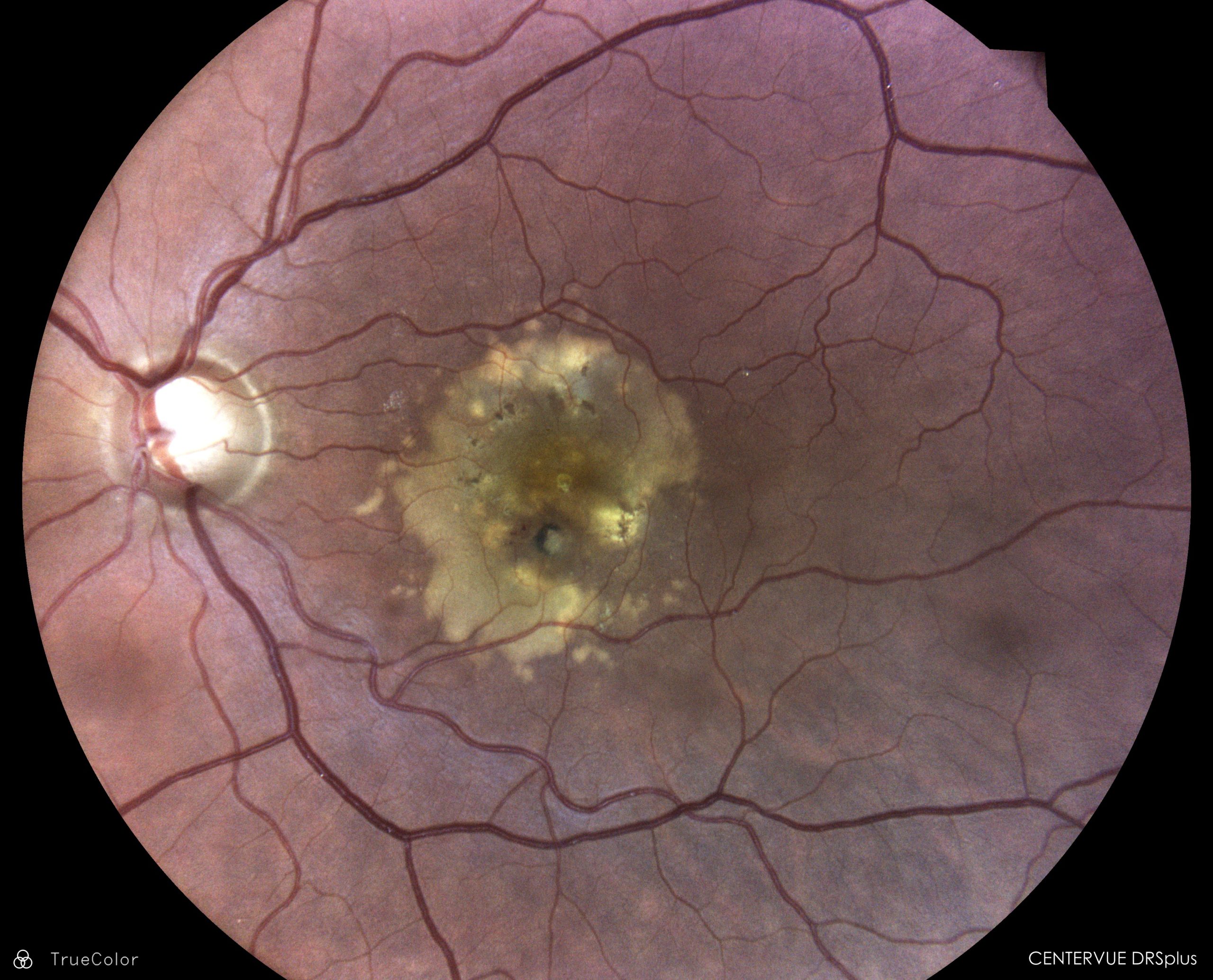 iCare DRSplus Fundus Görüntüleme - Görsel 3